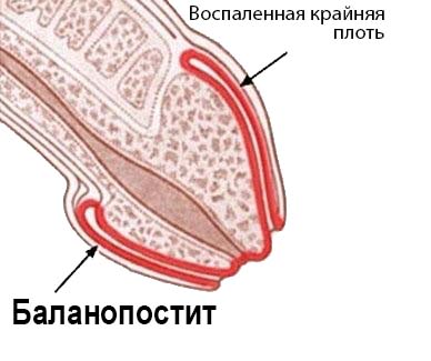 Баланопостит